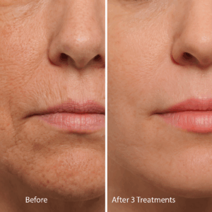 microneedling before after