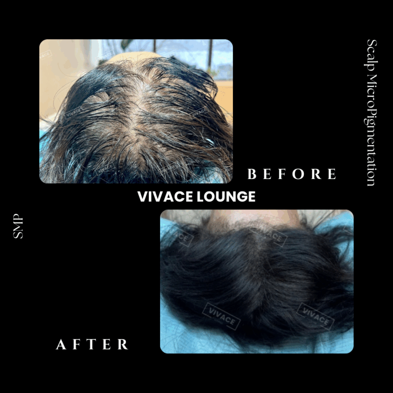 smp before after